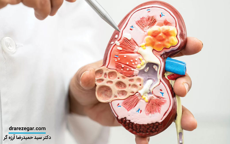 مراقبت های پس از جراحی سنگ کلیه در حالب