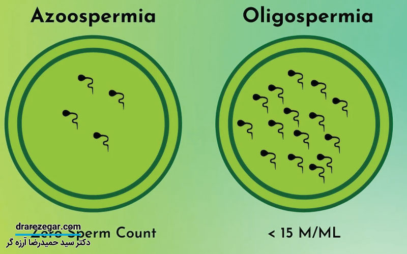 اسپرم صفر یا آزوسپرمی در مردان