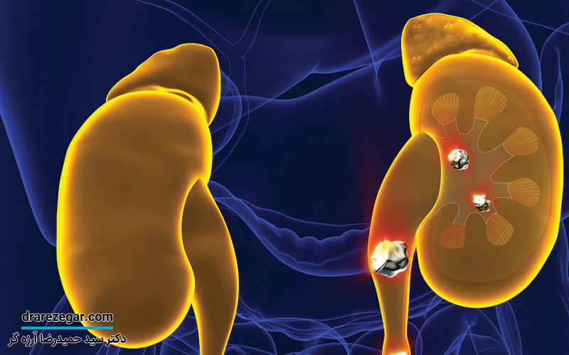 مقایسه روش های مختلف جراحی سنگ کلیه