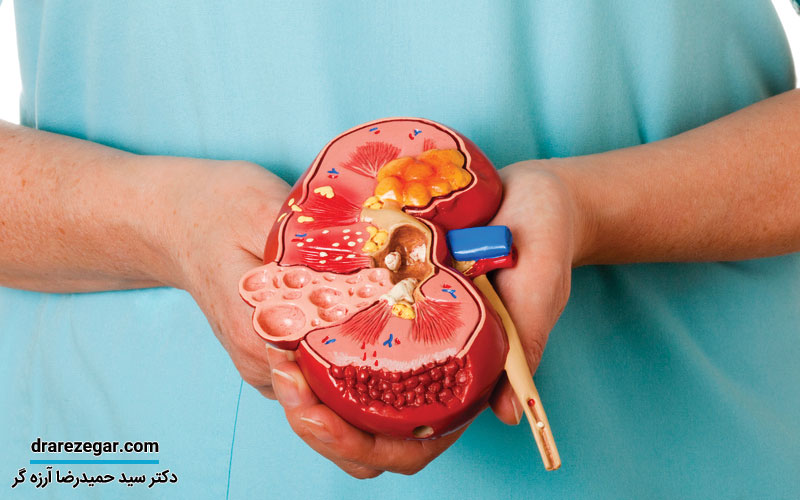 مقایسه روش های مختلف جراحی سنگ کلیه