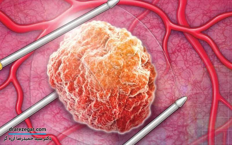 عوارض احتمالی پس از جراحی پروستات