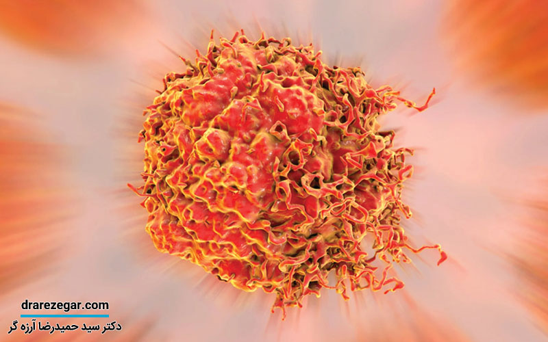 بهترین کاندیدا برای پروستاتکتومی