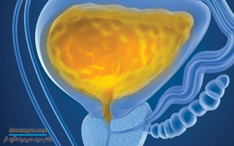 اختلال در تخلیه مثانه