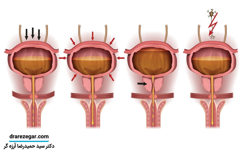 اختلال در تخلیه مثانه