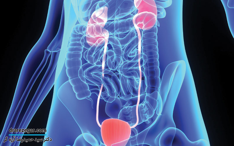 چگونه از بروز سنگ کلیه بعد از جراحی جلوگیری کنیم