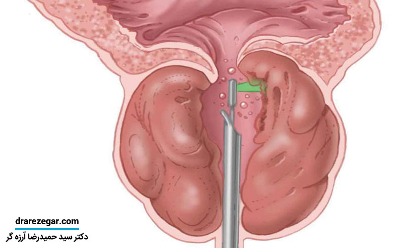 تفاوت درمان دارویی و جراحی در بزرگ شدن پروستات