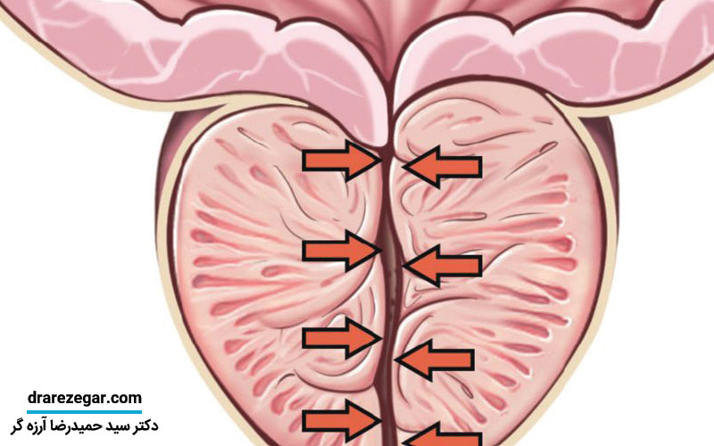 تفاوت درمان دارویی و جراحی در بزرگ شدن پروستات
