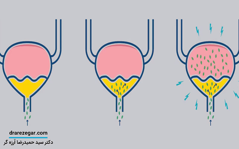 عفونت های مجاری ادراری (UTI) در مردان
