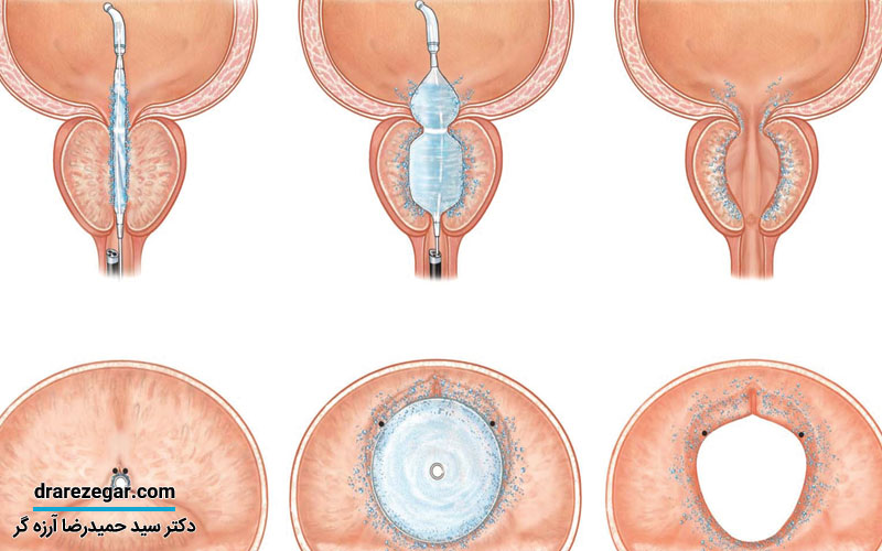 عمل لیزری پروستات چیست