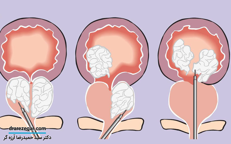 عمل لیزری پروستات چیست