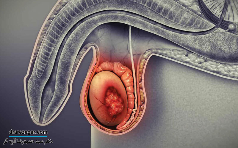 دلایل درد بیضه ها بدون وجود بیماری