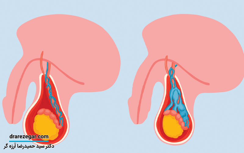 آیا واریکوسل بر کیفیت اسپرم تاثیر می گذارد