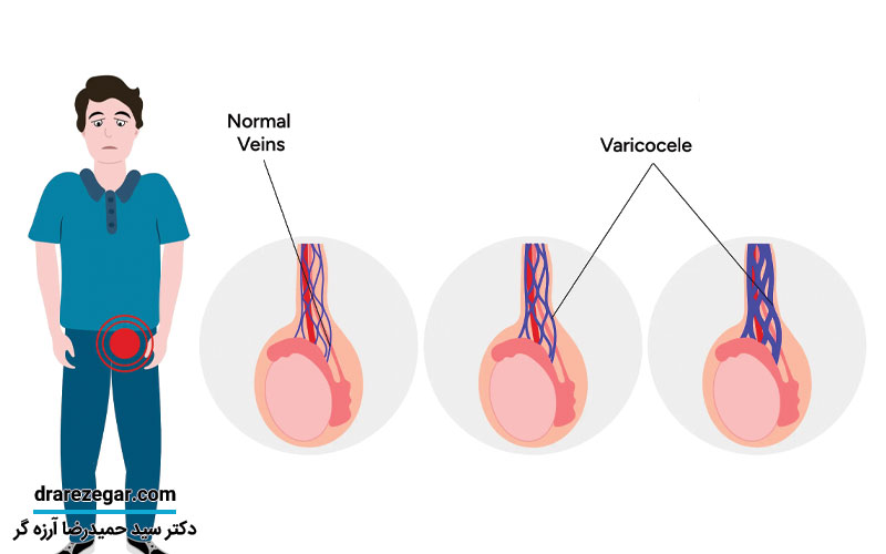 آیا واریکوسل بر کیفیت اسپرم تاثیر می گذارد