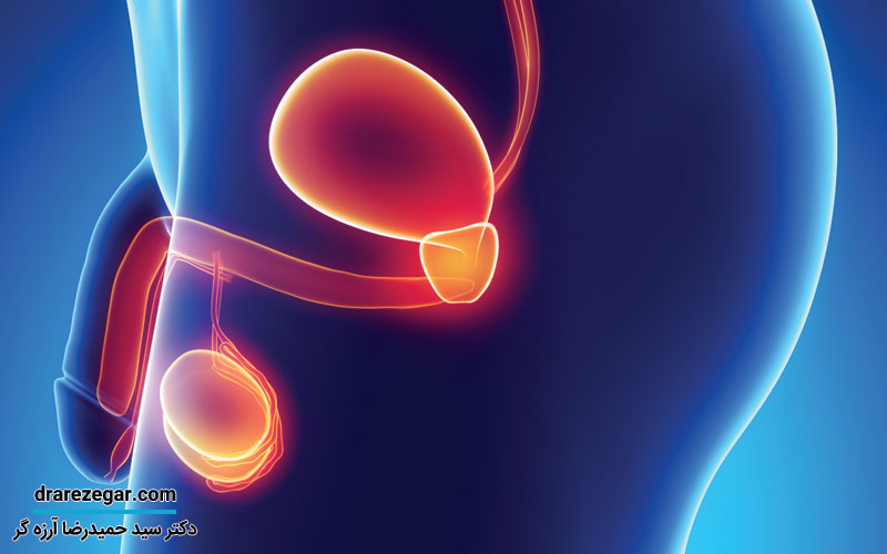 آیا واریکوسل بر کیفیت اسپرم تاثیر می گذارد
