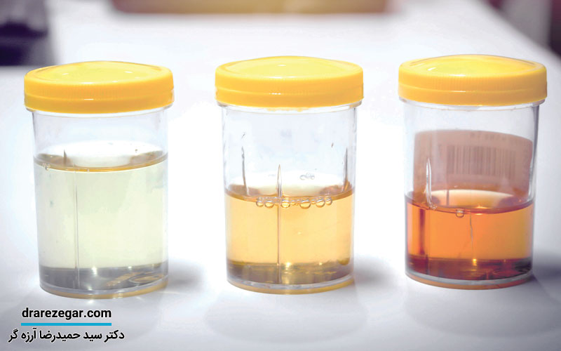 علت تغییر رنگ ادرار چیست