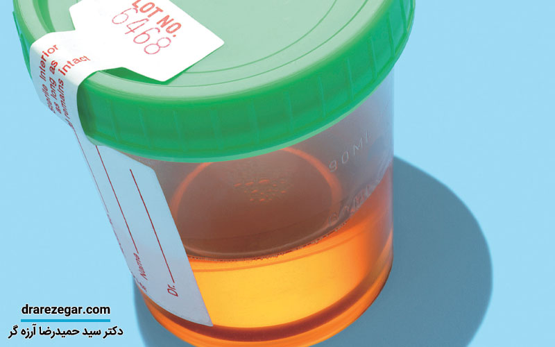 علت تغییر رنگ ادرار چیست