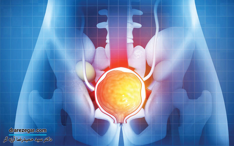 افتادگی کیسه بیضه