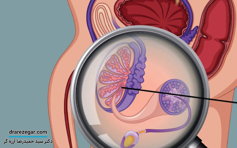 آیا واریکوسل باعث کاهش میل جنسی می شود