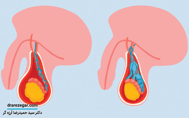آیا واریکوسل باعث کاهش میل جنسی می شود