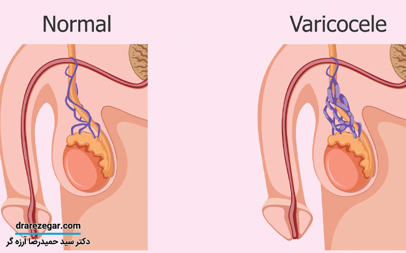 مراقبت های بعد از عمل واریکوسل