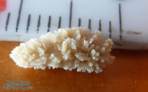علت تشکیل مجدد سنگ کلیه پس از سنگ شکنی