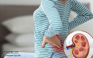 جلوگیری از بازگشت سنگ کلیه بعد از دفع طبیعی