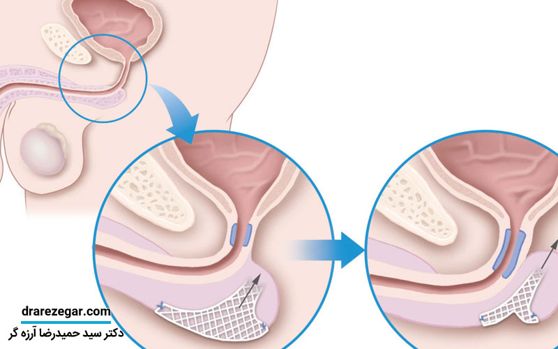دلایل و درمان عدم انزال در مردان