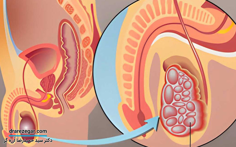 تشخیص زودهنگام سرطان بیضه