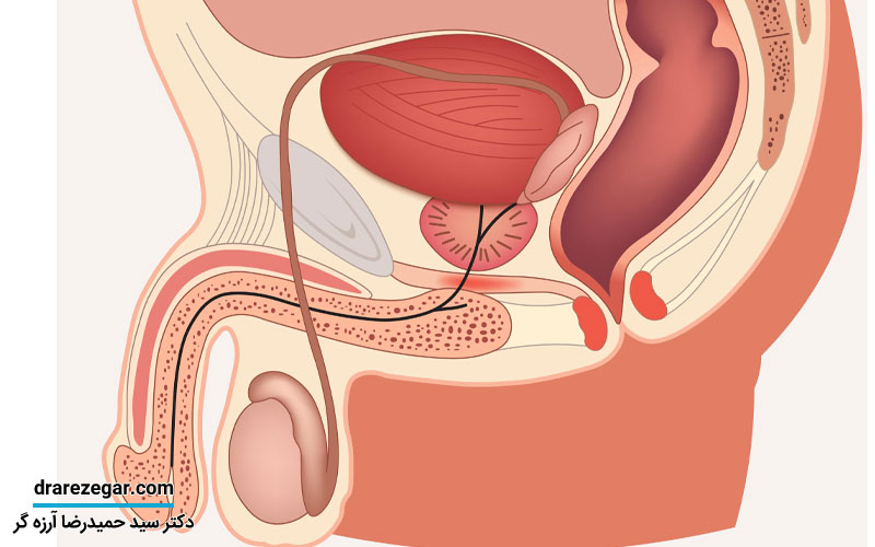 تشخیص زودهنگام سرطان بیضه