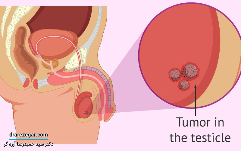 تشخیص زودهنگام سرطان بیضه