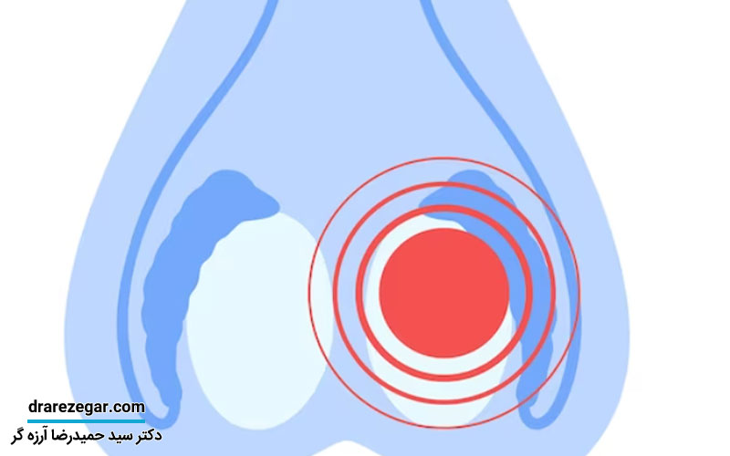 درمان کیست بیضه با روش های غیرجراحی
