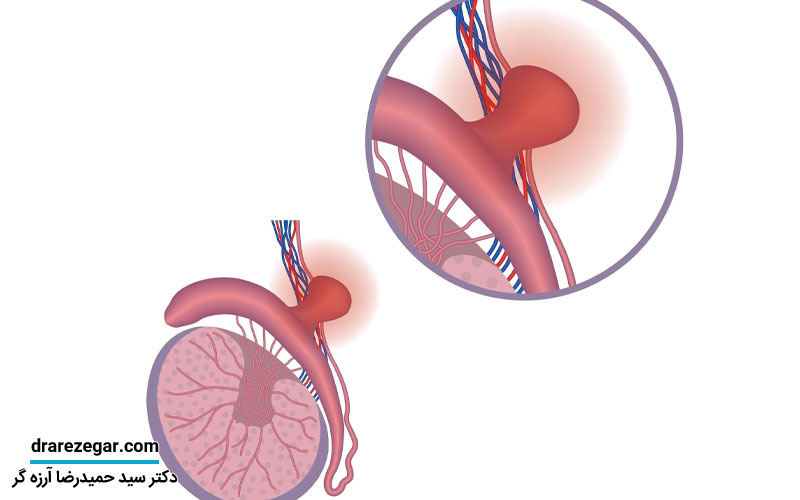 درمان کیست بیضه با روش های غیرجراحی