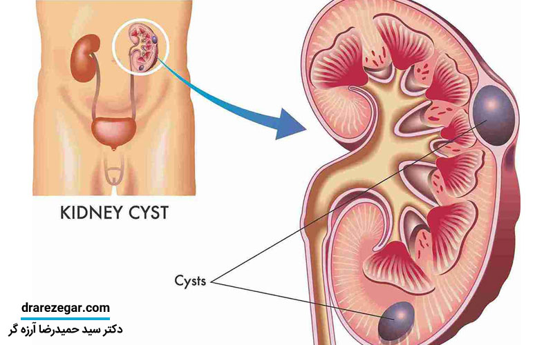 جراحی برداشتن کیست کلیه