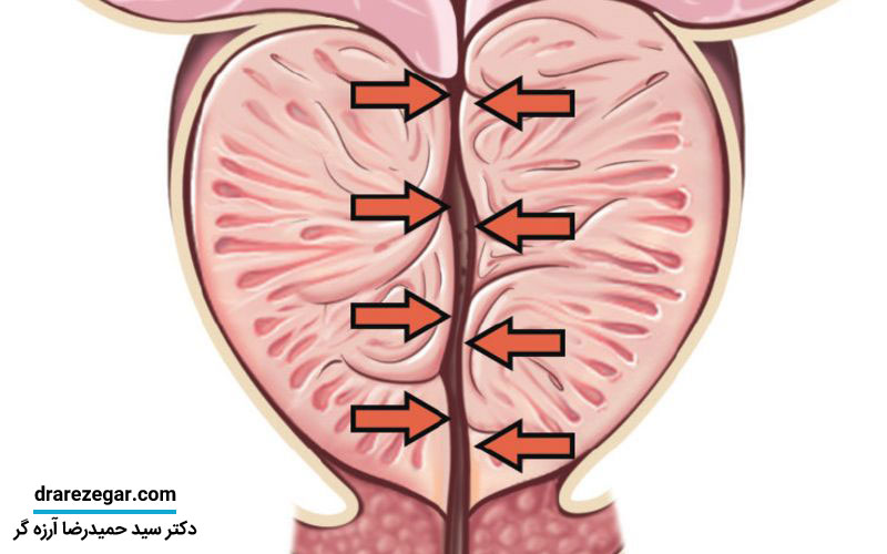 انسداد مجرای ادرار در مردان