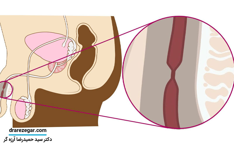 علائم هشداردهنده تنگی مجرای ادراری