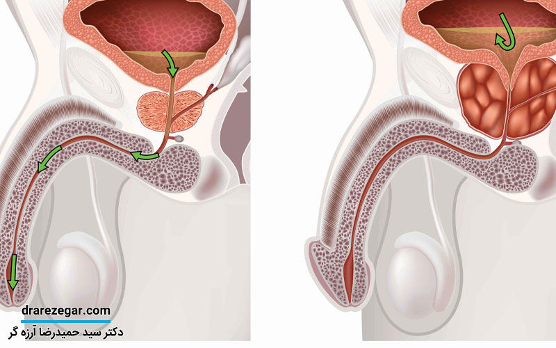چه زمانی افتادگی بیضه طبیعی است