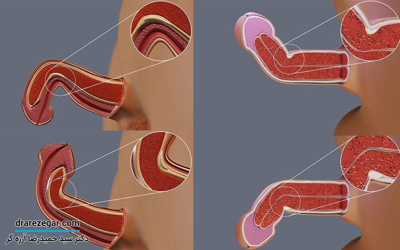 بهترین روش درمان انحنای آلت تناسلی