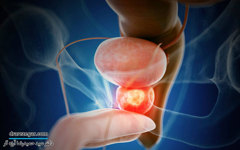 درمان سرطان پروستات