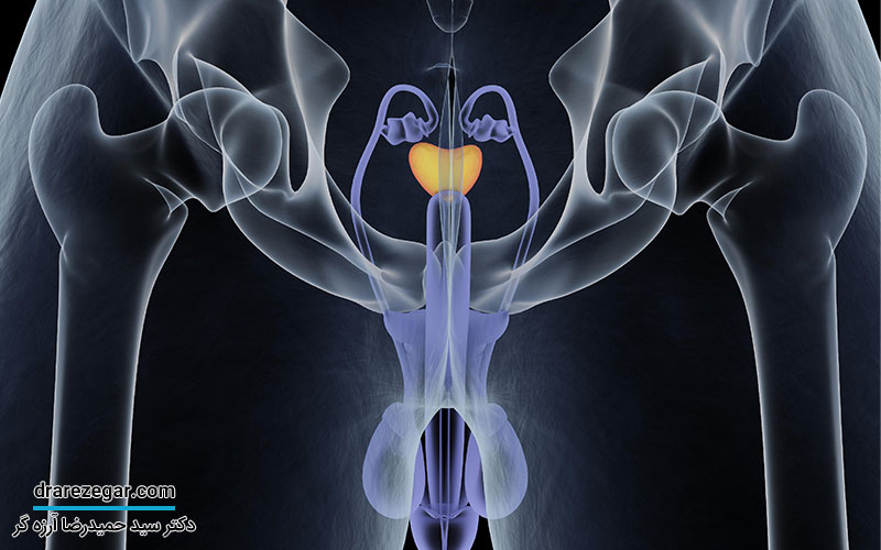 درمان سرطان پروستات