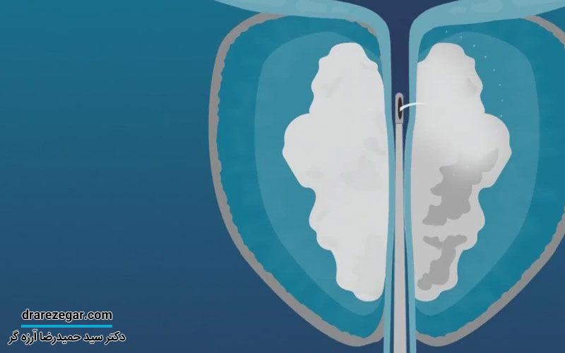 بهترین روش های غیرجراحی درمان بزرگی پروستات