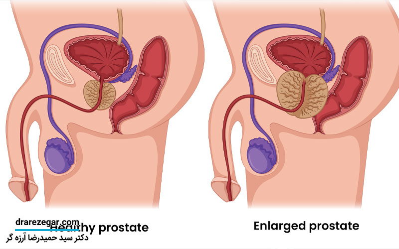 بهترین روش های غیرجراحی درمان بزرگی پروستات