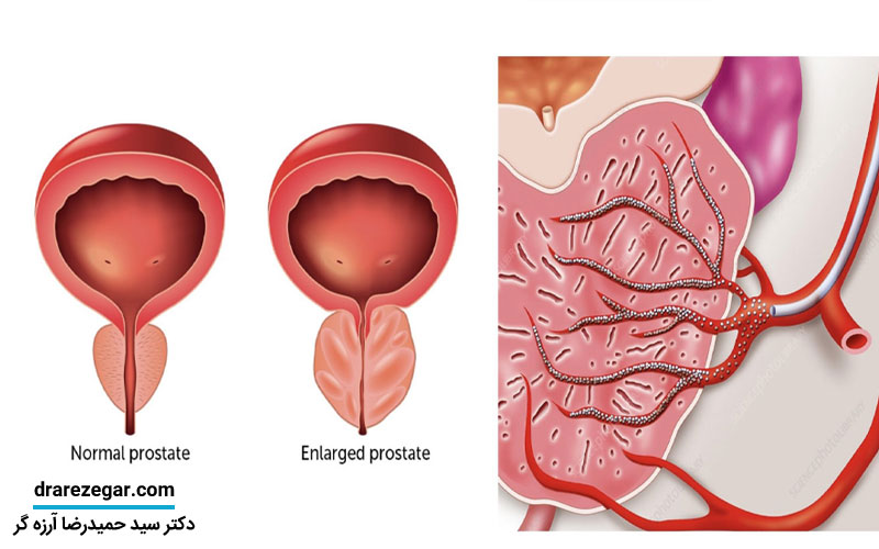 بهترین روش های غیرجراحی درمان بزرگی پروستات