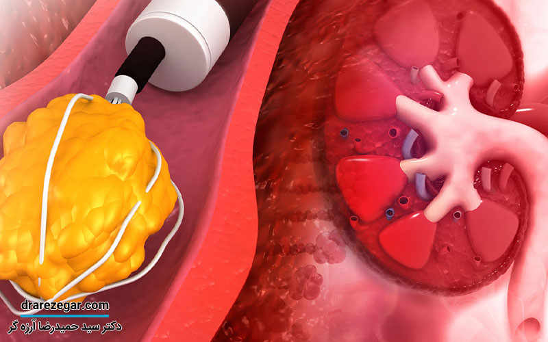 دفع سنگ کلیه و مجاری ادراری