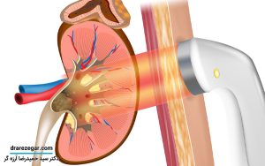 دفع سنگ کلیه و مجاری ادراری