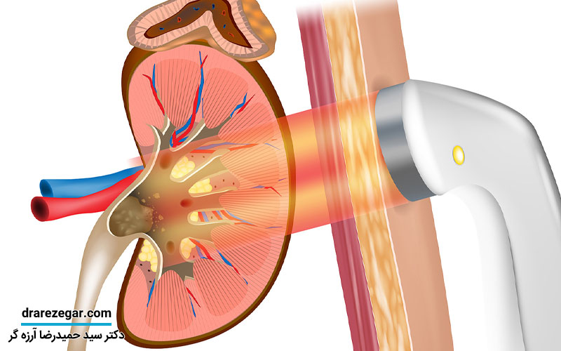 دفع سنگ کلیه و مجاری ادراری