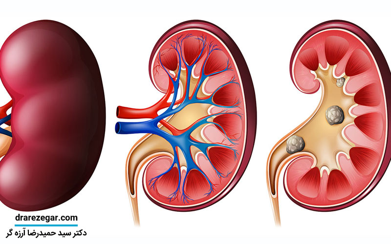 دفع سنگ کلیه و مجاری ادراری