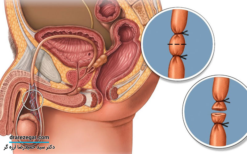 وازکتومی چیست
