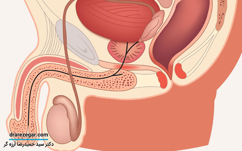 وازکتومی چیست