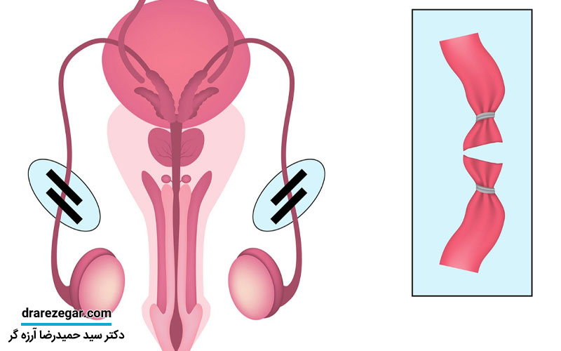 وازکتومی چیست