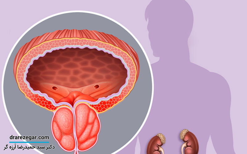جوانان هم دچار سرطان پروستات میشوند